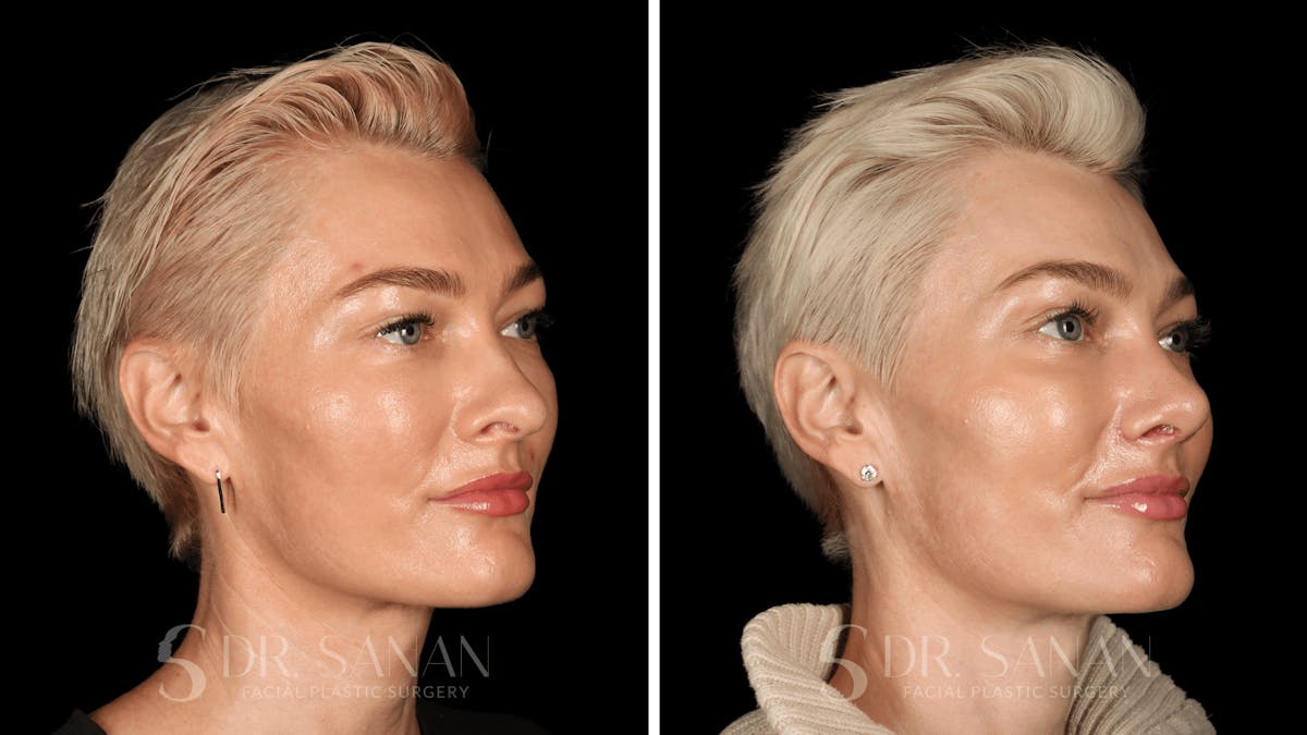 Rhinoplasty Before & After Gallery - Patient 220805 - Image 7