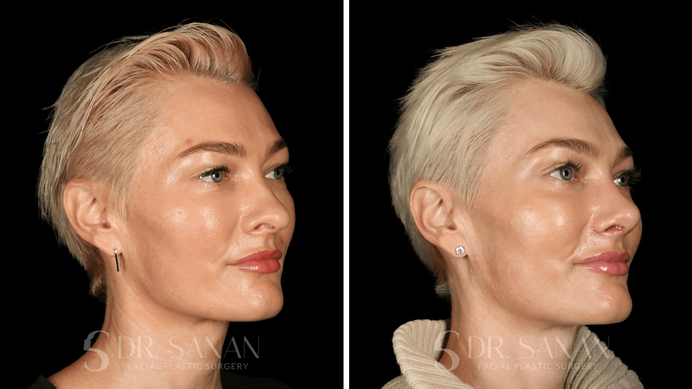 Rhinoplasty Before & After Gallery - Patient 220805 - Image 7