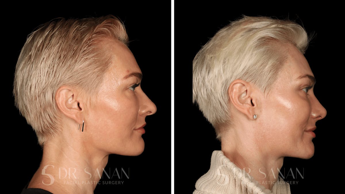 Rhinoplasty Before & After Gallery - Patient 220805 - Image 8