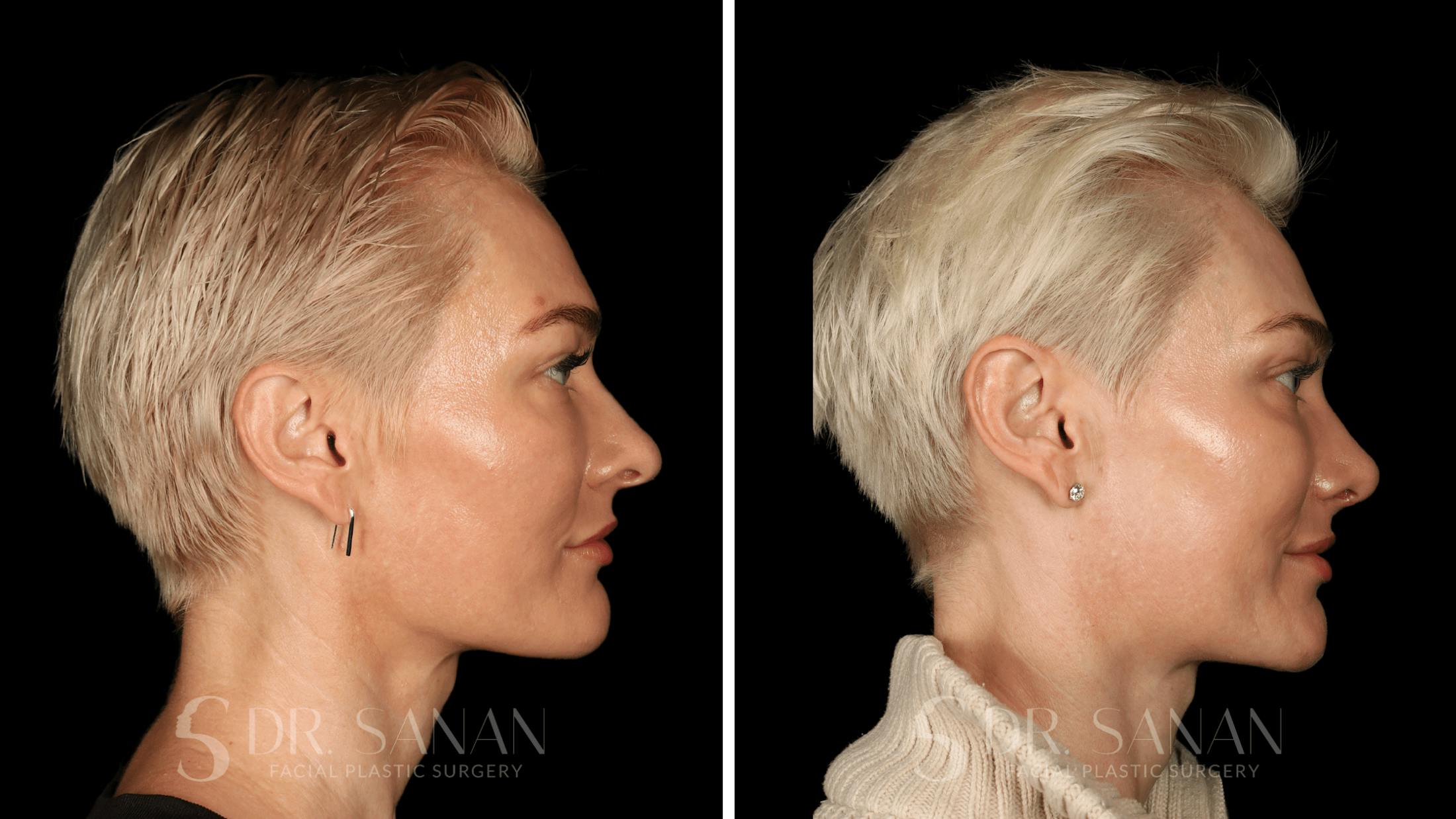 Rhinoplasty Before & After Gallery - Patient 220805 - Image 8