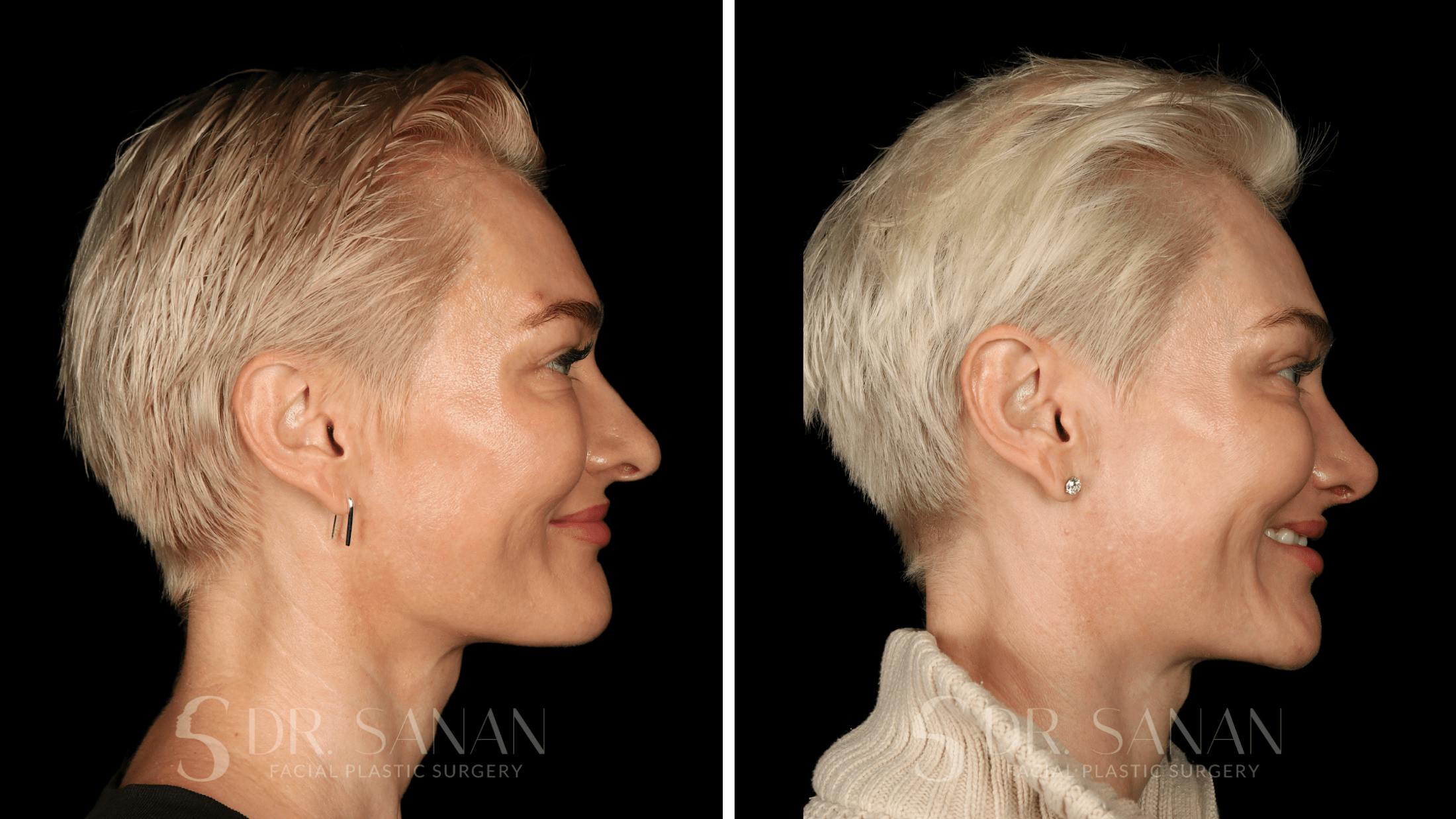 Rhinoplasty Before & After Gallery - Patient 220805 - Image 1