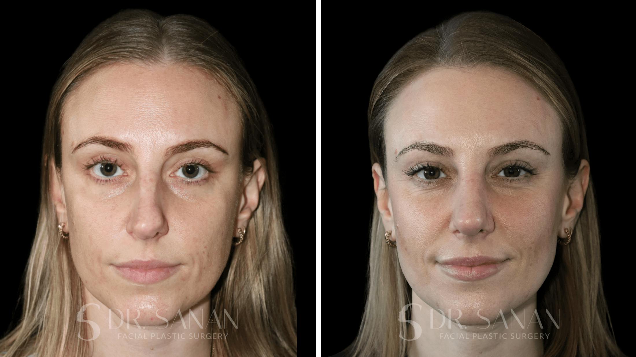 Rhinoplasty Before & After Gallery - Patient 339910 - Image 3