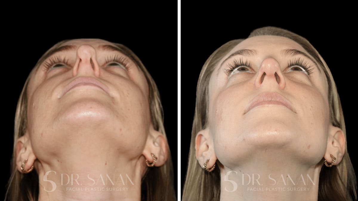 Rhinoplasty Before & After Gallery - Patient 339910 - Image 4