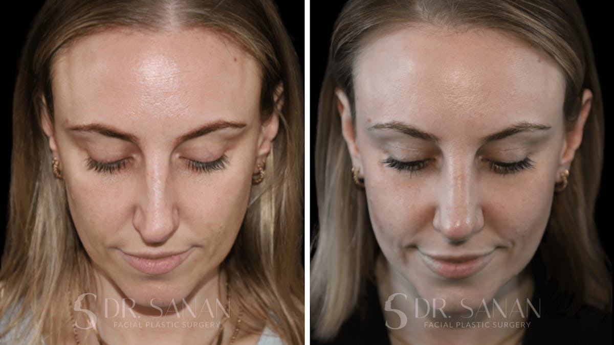 Rhinoplasty Before & After Gallery - Patient 339910 - Image 5