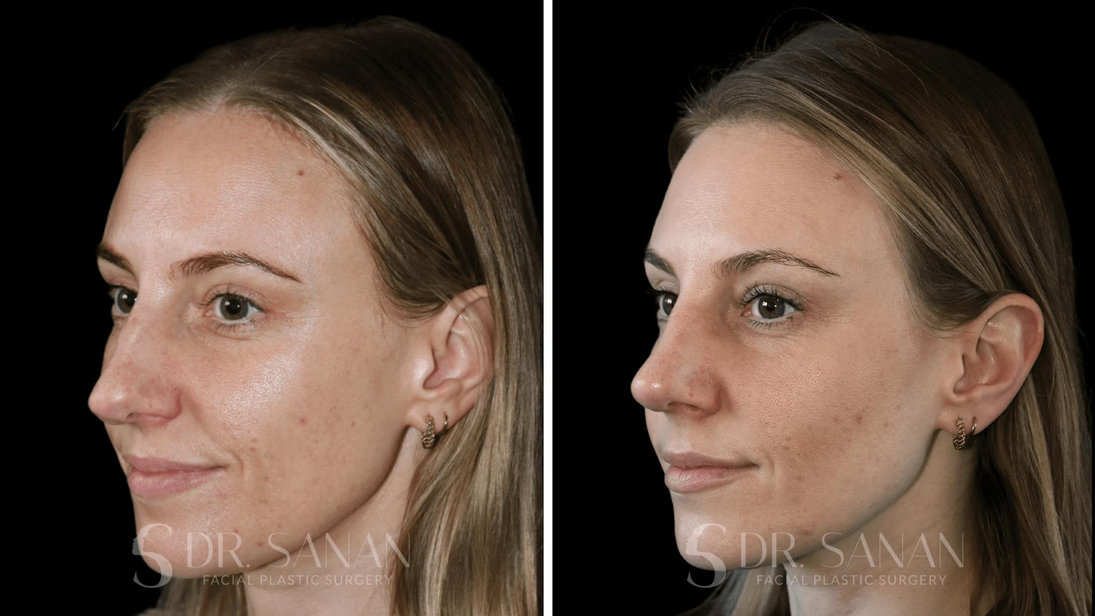 Rhinoplasty Before & After Gallery - Patient 339910 - Image 2