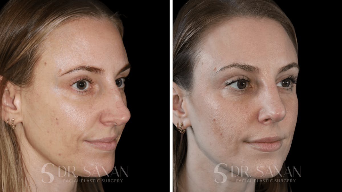 Rhinoplasty Before & After Gallery - Patient 339910 - Image 1