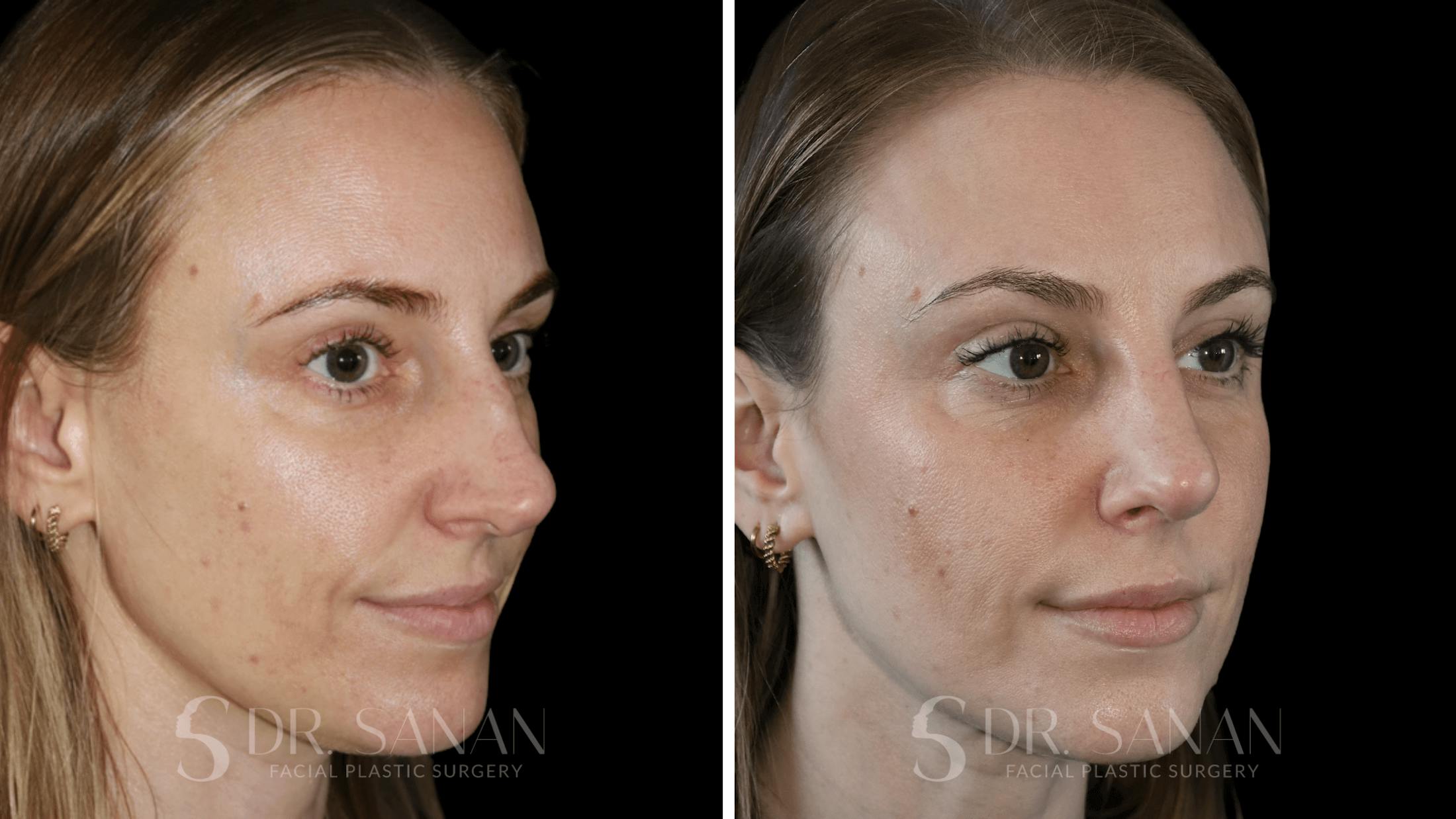 Rhinoplasty Before & After Gallery - Patient 339910 - Image 1