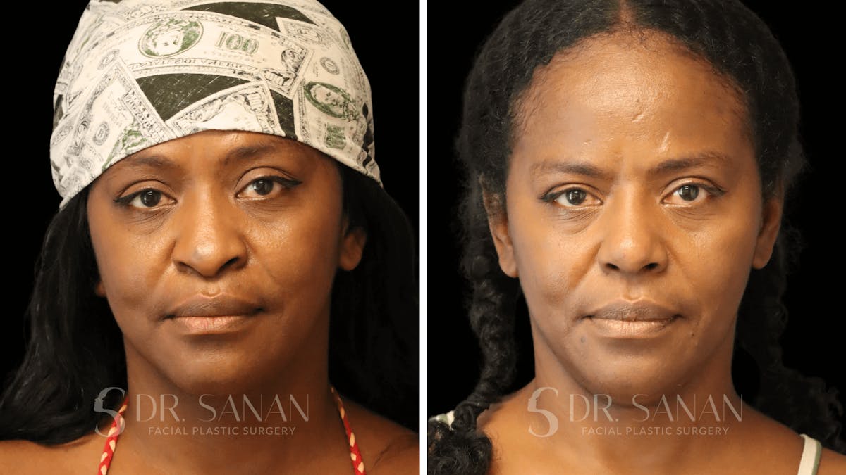Rhinoplasty Before & After Gallery - Patient 138096 - Image 3