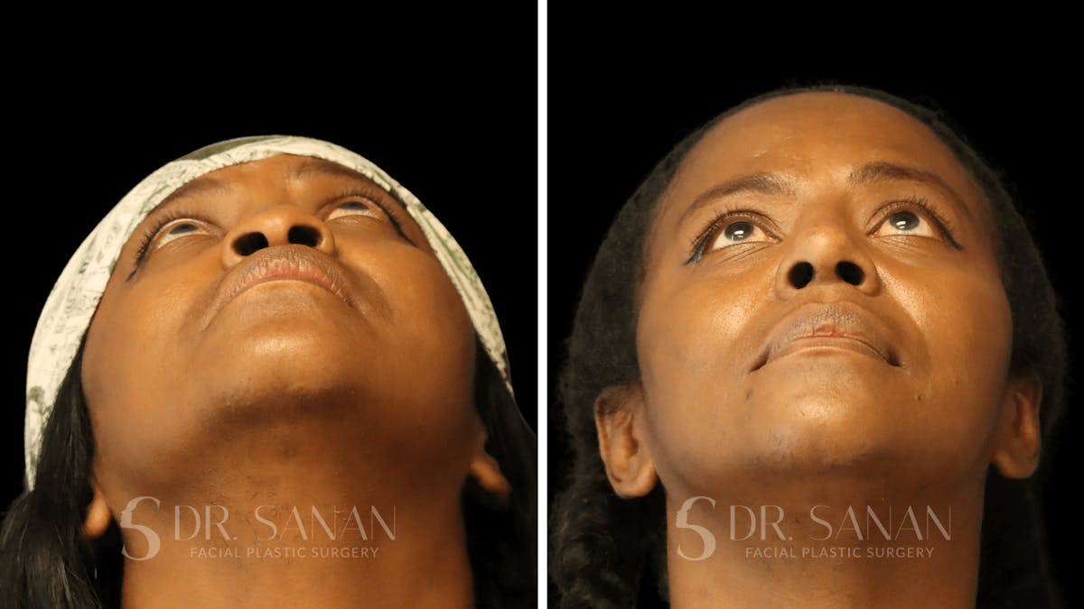 Rhinoplasty Before & After Gallery - Patient 138096 - Image 4