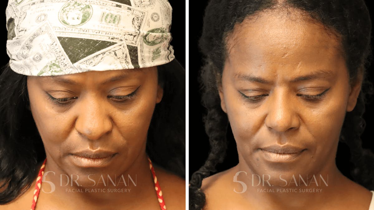 Rhinoplasty Before & After Gallery - Patient 138096 - Image 5