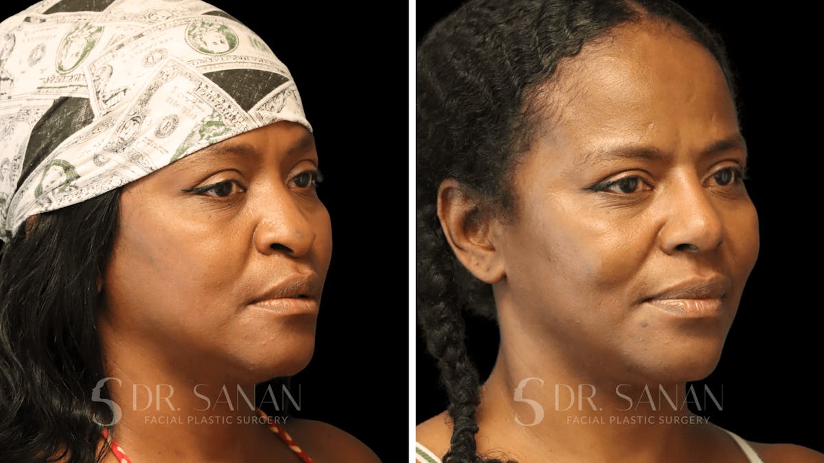 Rhinoplasty Before & After Gallery - Patient 138096 - Image 6