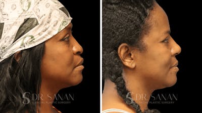 Rhinoplasty Before & After Gallery - Patient 138096 - Image 1
