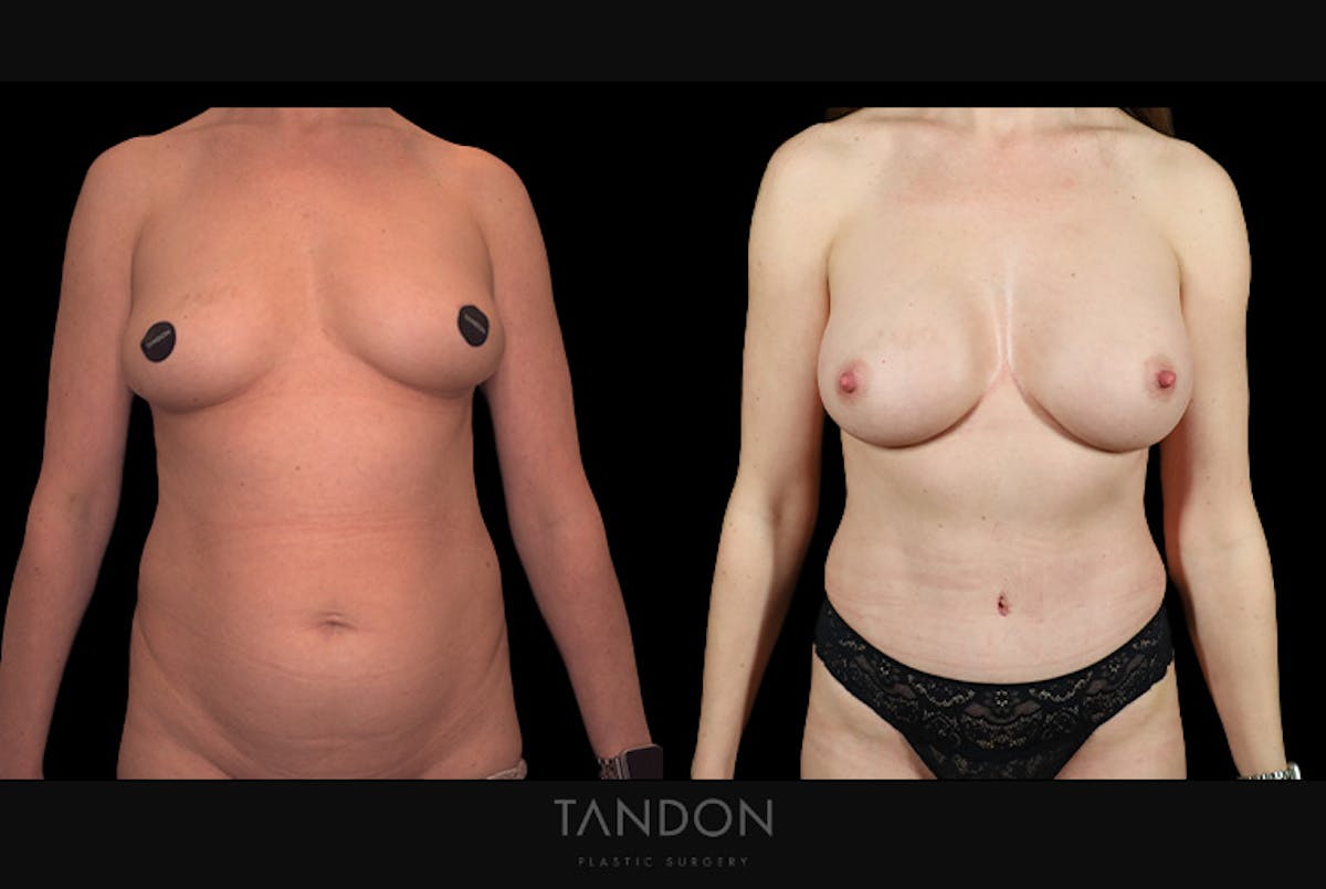 Mommy Makeover Before & After Gallery - Patient 102251 - Image 1