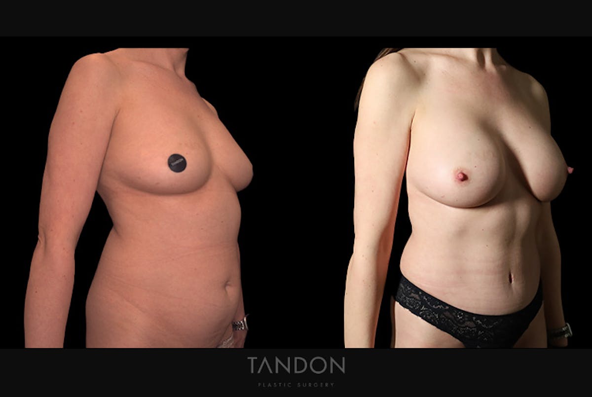 Mommy Makeover Before & After Gallery - Patient 102251 - Image 2