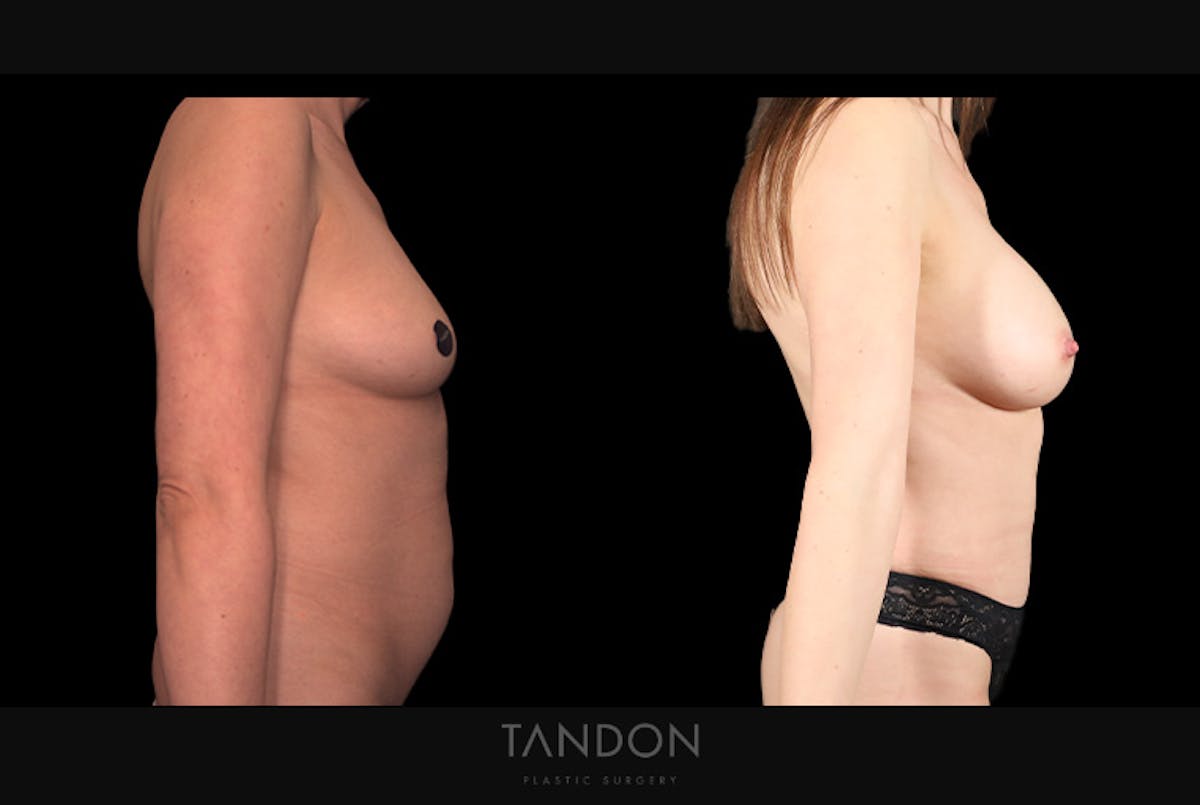 Mommy Makeover Before & After Gallery - Patient 102251 - Image 3