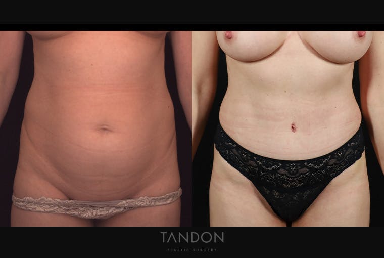 Abdominoplasty (Tummy Tuck) Before & After Gallery - Patient 499399 - Image 1