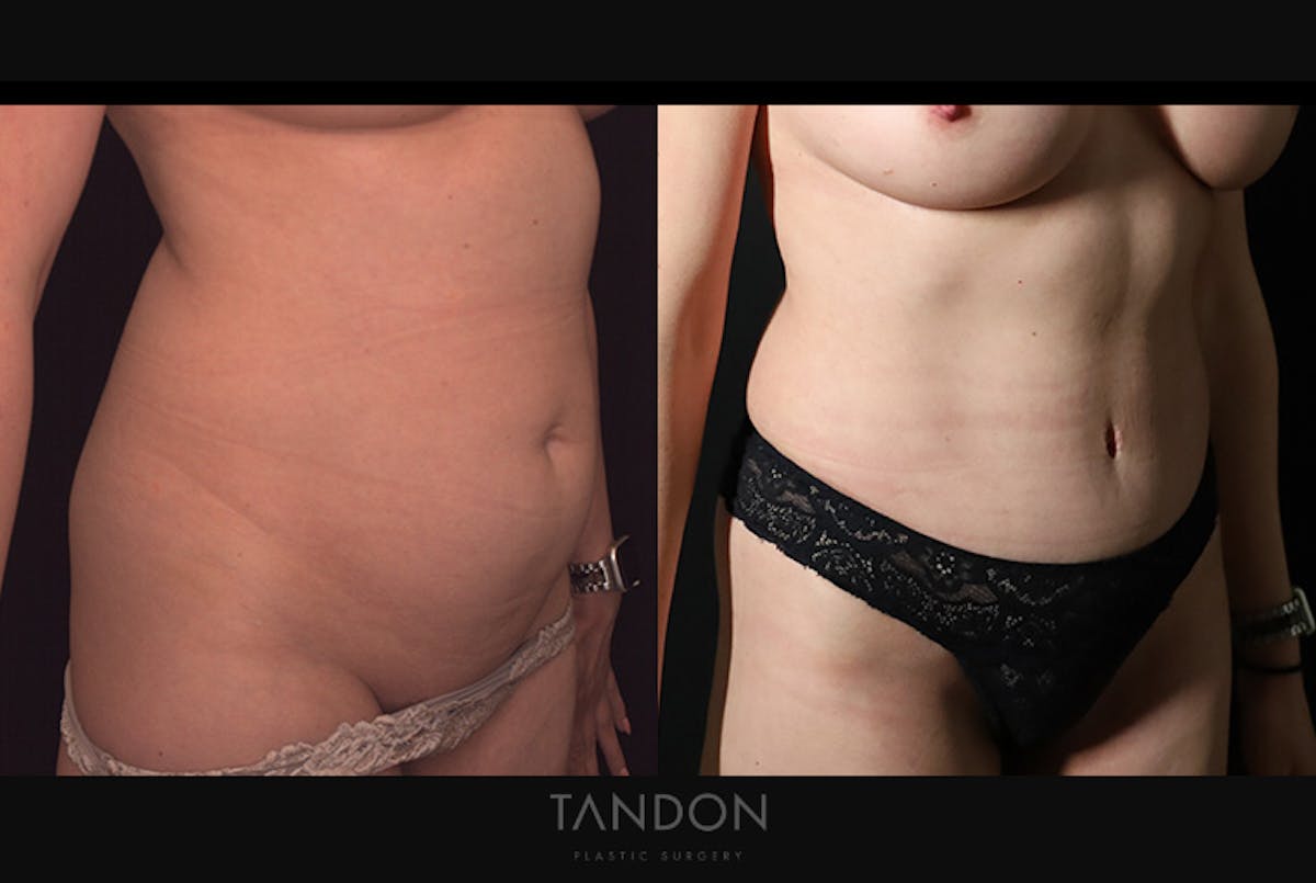 Abdominoplasty (Tummy Tuck) Before & After Gallery - Patient 499399 - Image 2