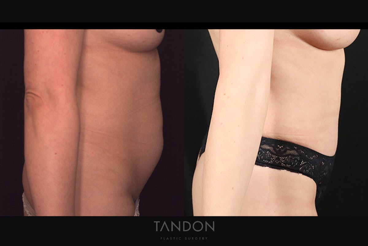 Abdominoplasty (Tummy Tuck) Before & After Gallery - Patient 499399 - Image 3