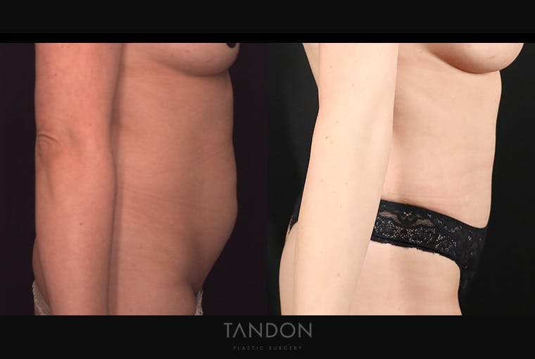 Abdominoplasty (Tummy Tuck) Before & After Gallery - Patient 499399 - Image 3