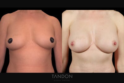 Breast Augmentation Before & After Gallery - Patient 867583 - Image 1