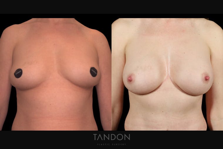 Breast Augmentation Before & After Gallery - Patient 867583 - Image 1