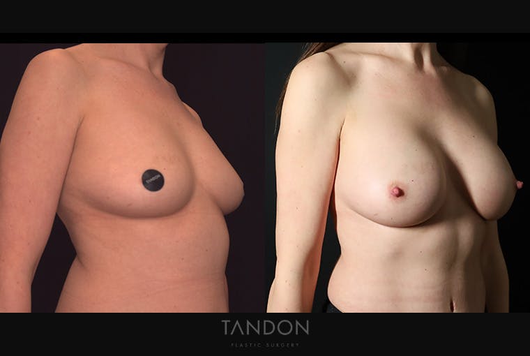Breast Augmentation Before & After Gallery - Patient 867583 - Image 2