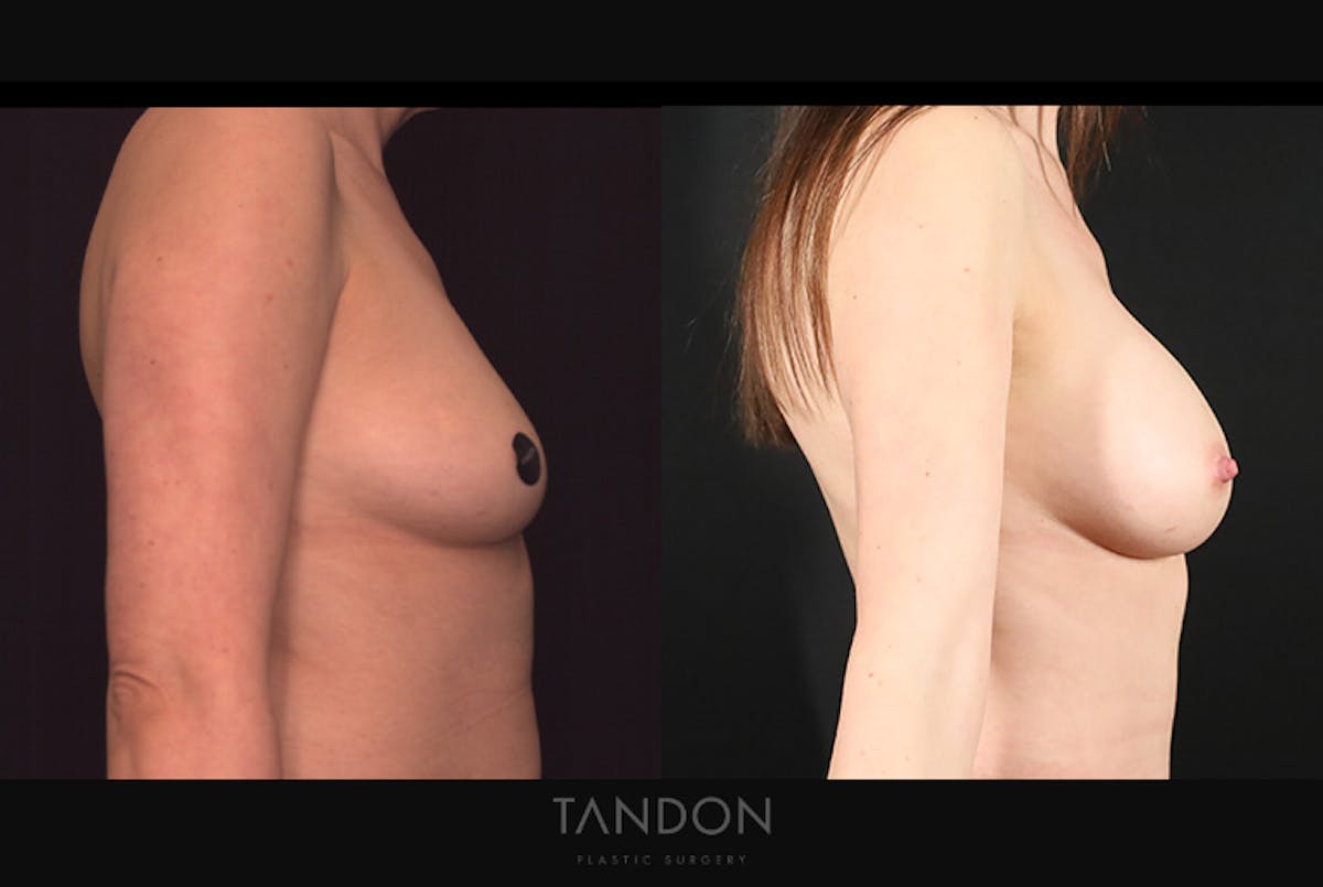 Breast Augmentation Before & After Gallery - Patient 867583 - Image 3