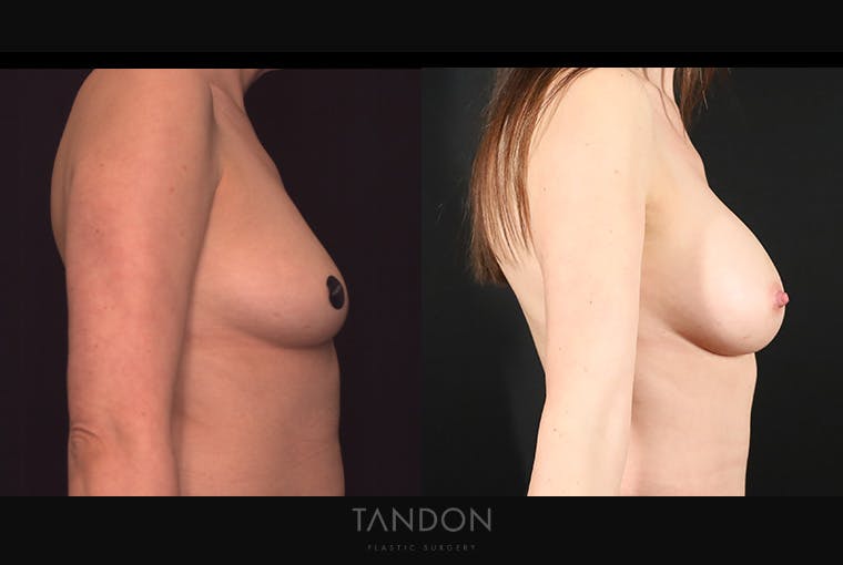 Breast Augmentation Before & After Gallery - Patient 867583 - Image 3