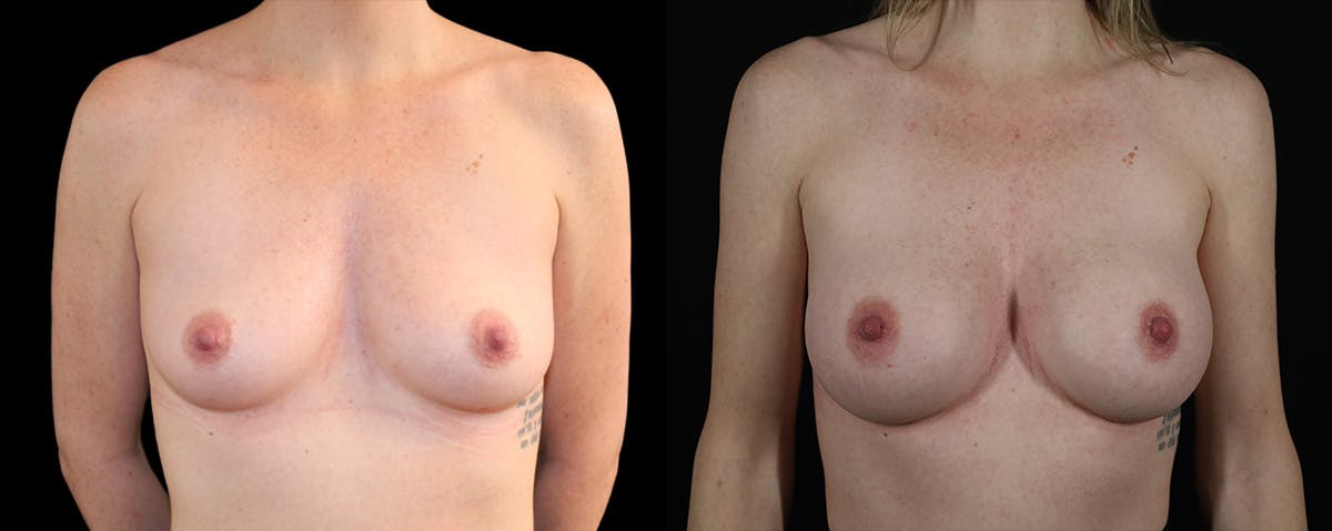 Breast Augmentation  Before & After Gallery - Patient 152264 - Image 1