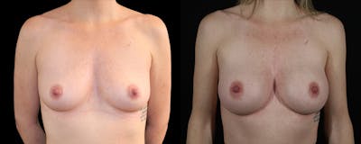 Breast Augmentation Before & After Gallery - Patient 152264 - Image 1