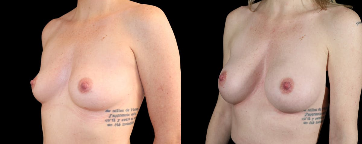 Breast Augmentation  Before & After Gallery - Patient 152264 - Image 2