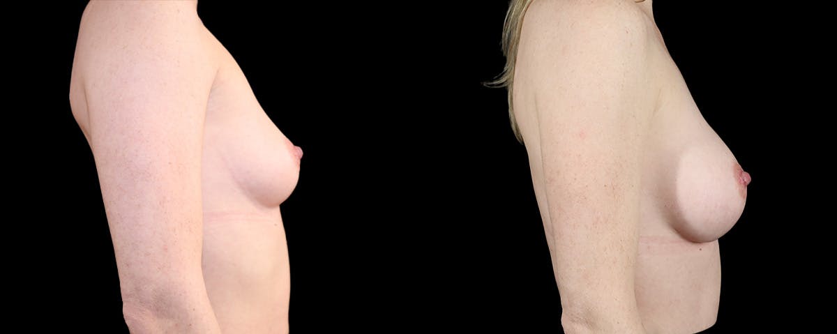Breast Augmentation  Before & After Gallery - Patient 152264 - Image 3