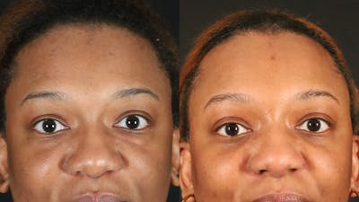 Blepharoplasty Before & After Gallery - Patient 318347 - Image 1