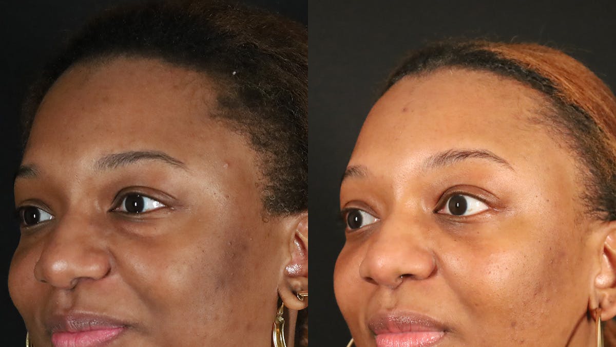 Blepharoplasty Before & After Gallery - Patient 318347 - Image 2