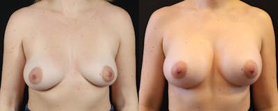 Breast Augmentation Before & After Gallery - Patient 114485 - Image 1