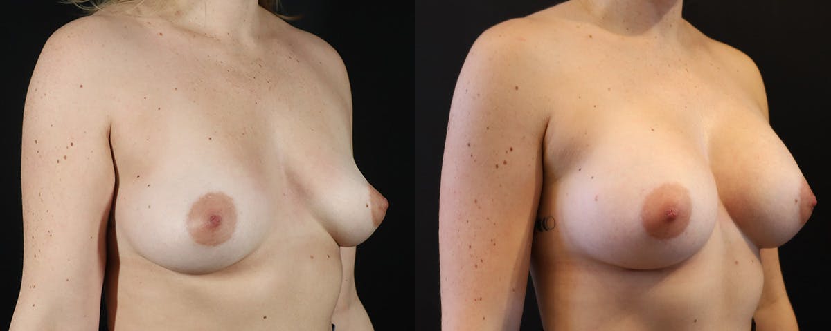 Breast Augmentation  Before & After Gallery - Patient 114485 - Image 2