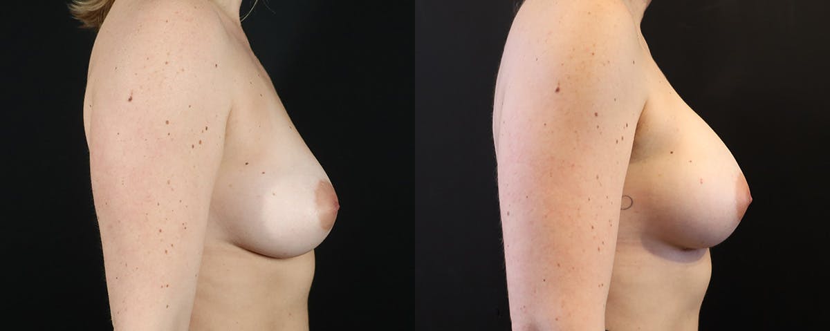 Breast Augmentation  Before & After Gallery - Patient 114485 - Image 3