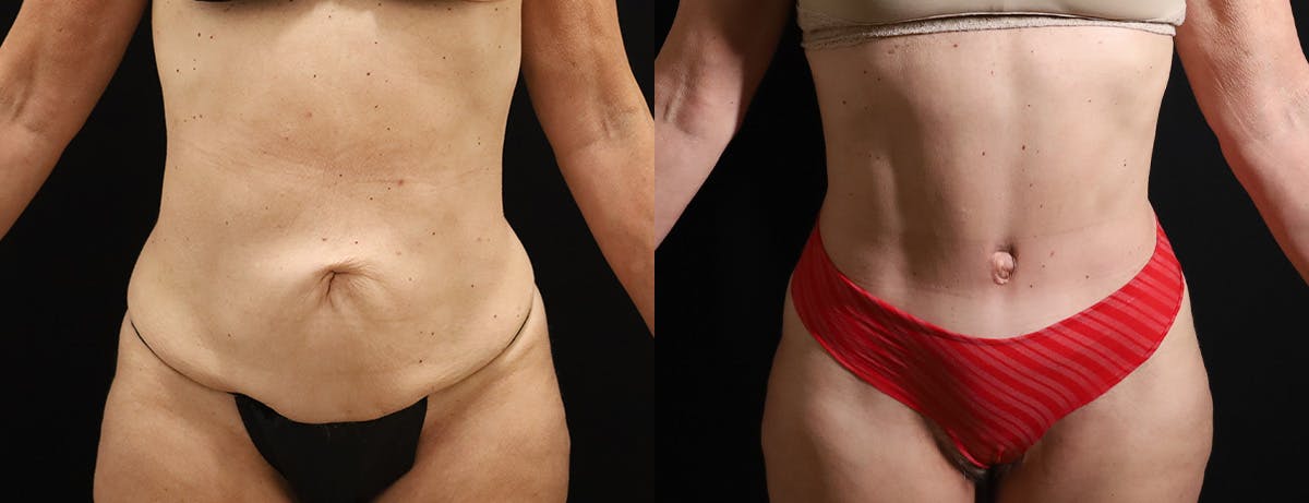 Abdominoplasty (Tummy Tuck) Before & After Gallery - Patient 338947 - Image 1