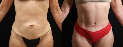 Abdominoplasty (Tummy Tuck) Before & After Gallery - Patient 338947 - Image 1