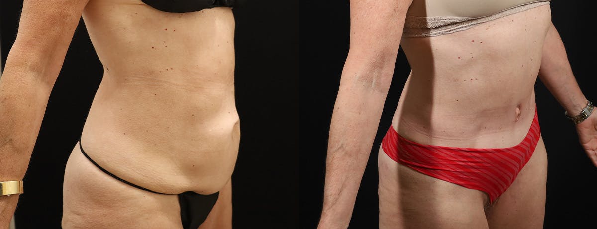 Abdominoplasty (Tummy Tuck) Before & After Gallery - Patient 338947 - Image 2