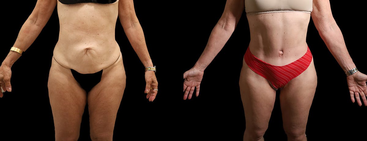 Thigh Lift Before & After Gallery - Patient 179043 - Image 1