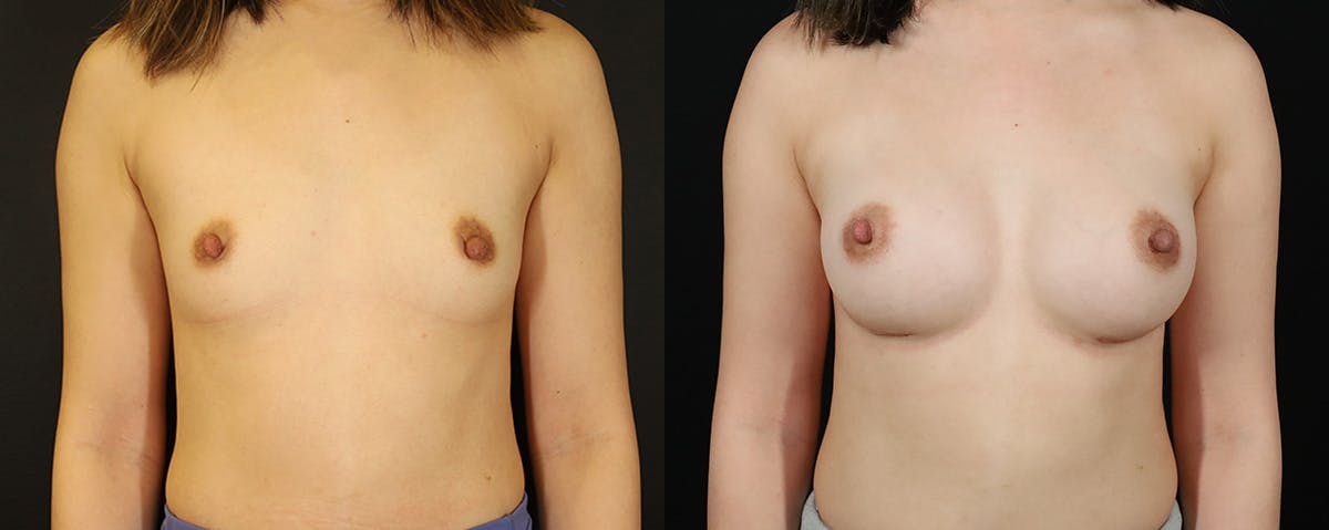Breast Augmentation  Before & After Gallery - Patient 152731 - Image 1