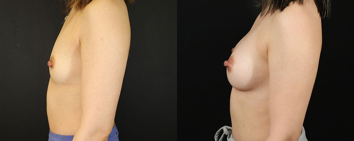 Breast Augmentation  Before & After Gallery - Patient 152731 - Image 3