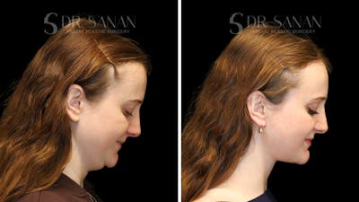 Neck Lift Before & After Gallery - Patient 498030 - Image 1