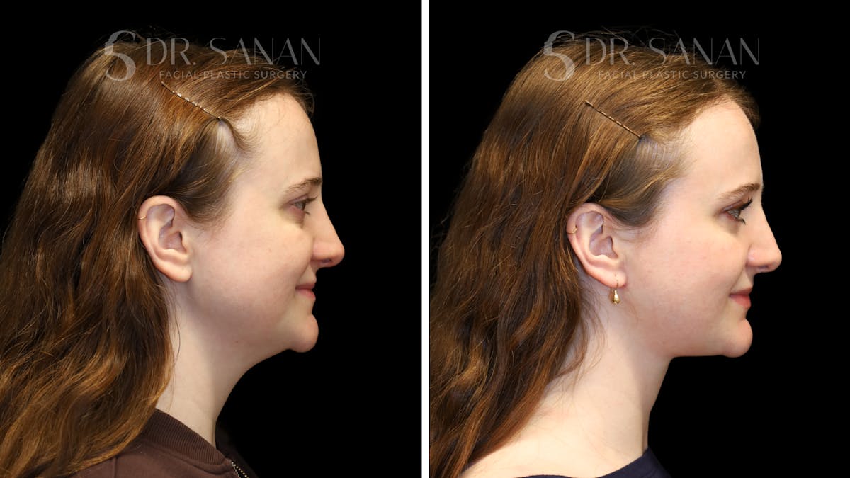 Neck Lift Before & After Gallery - Patient 498030 - Image 3
