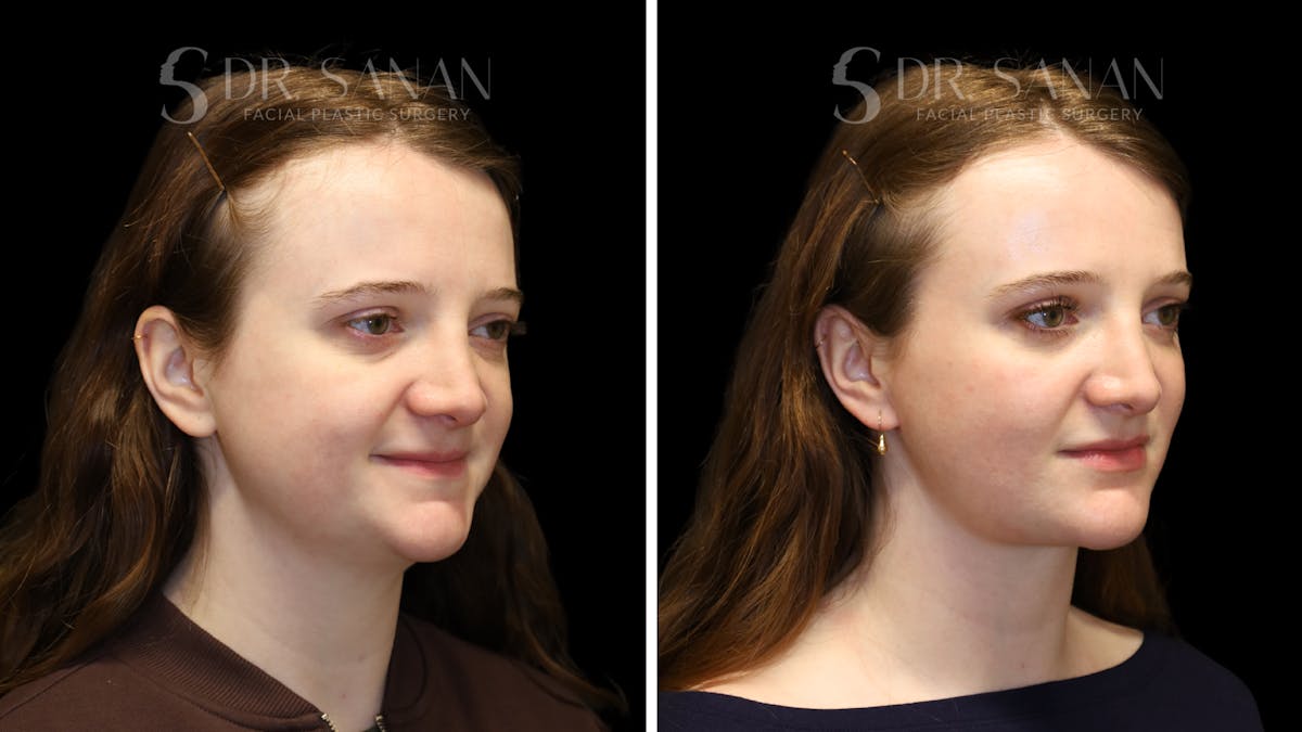 Neck Lift Before & After Gallery - Patient 498030 - Image 4