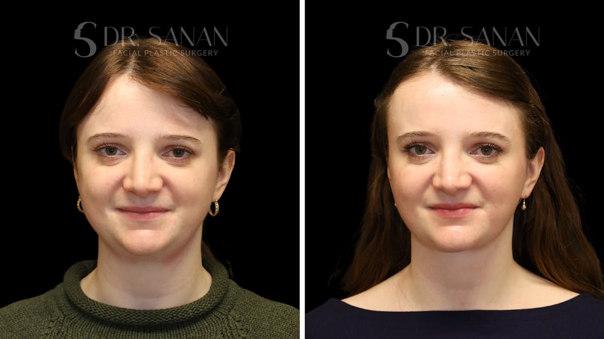 Neck Lift Before & After Gallery - Patient 498030 - Image 1