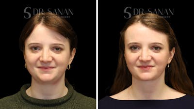 Neck Lift Before & After Gallery - Patient 498030 - Image 1