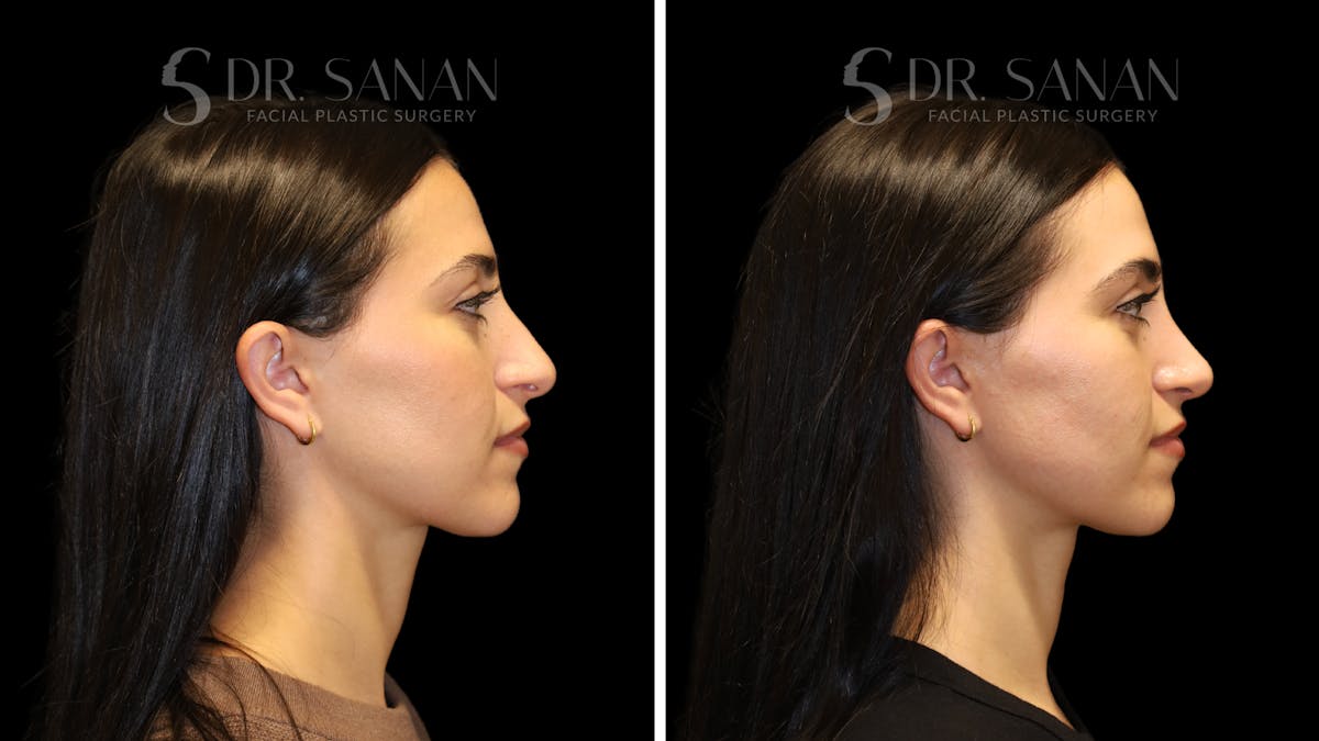 Rhinoplasty Before & After Gallery - Patient 712700 - Image 2