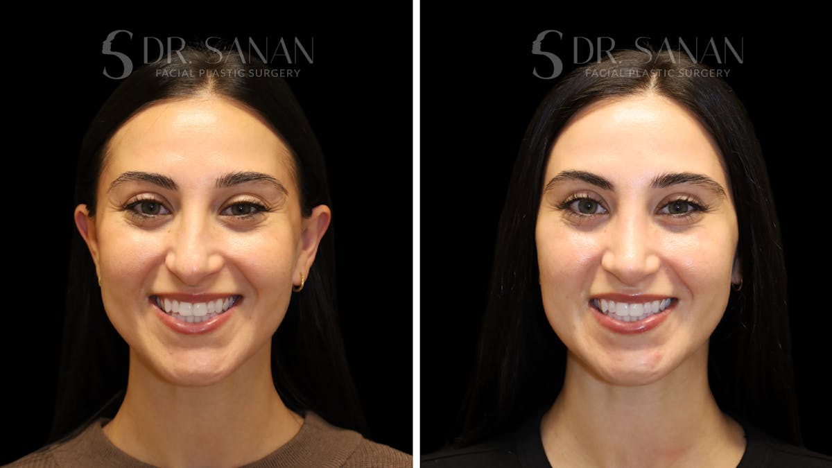 Rhinoplasty Before & After Gallery - Patient 712700 - Image 4